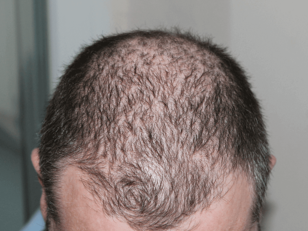 Male pattern hair loss of the front and crown of the head, demonstrating the type of diffuse thinning for which hair fibers can be used.