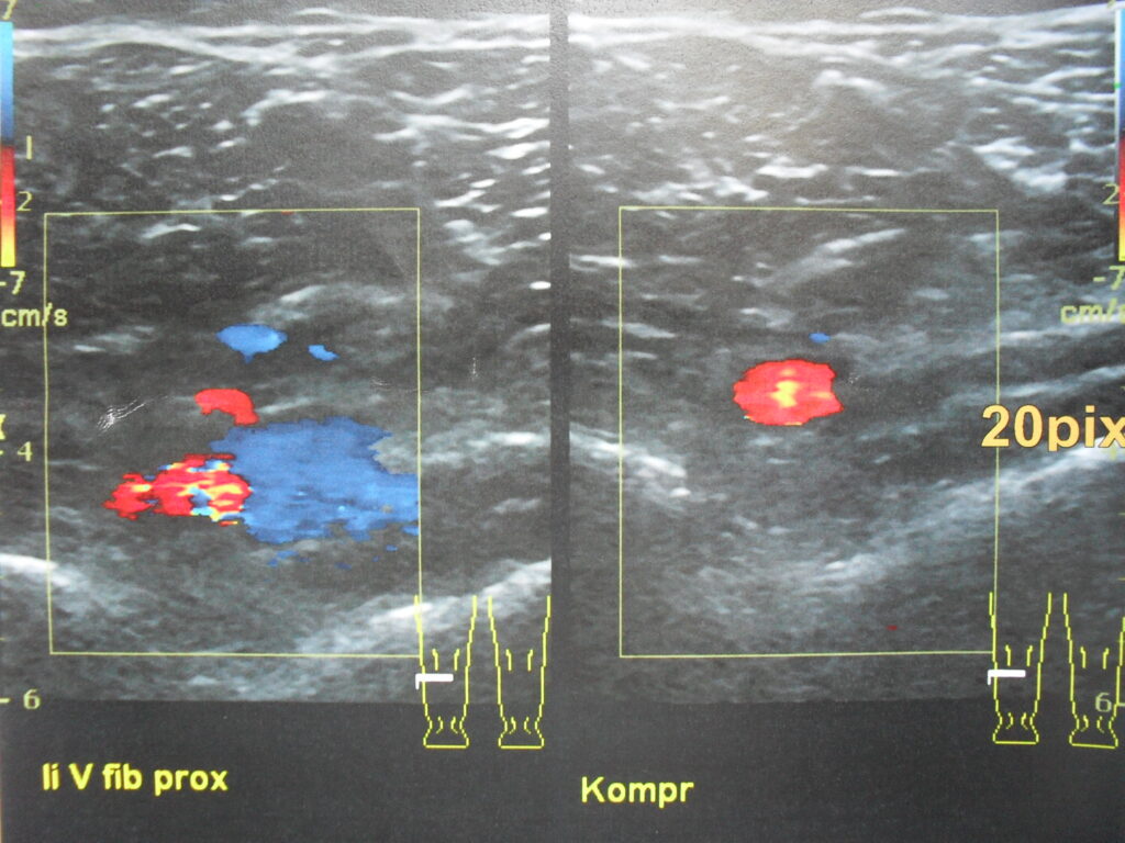 DVT detection by ultrasound.