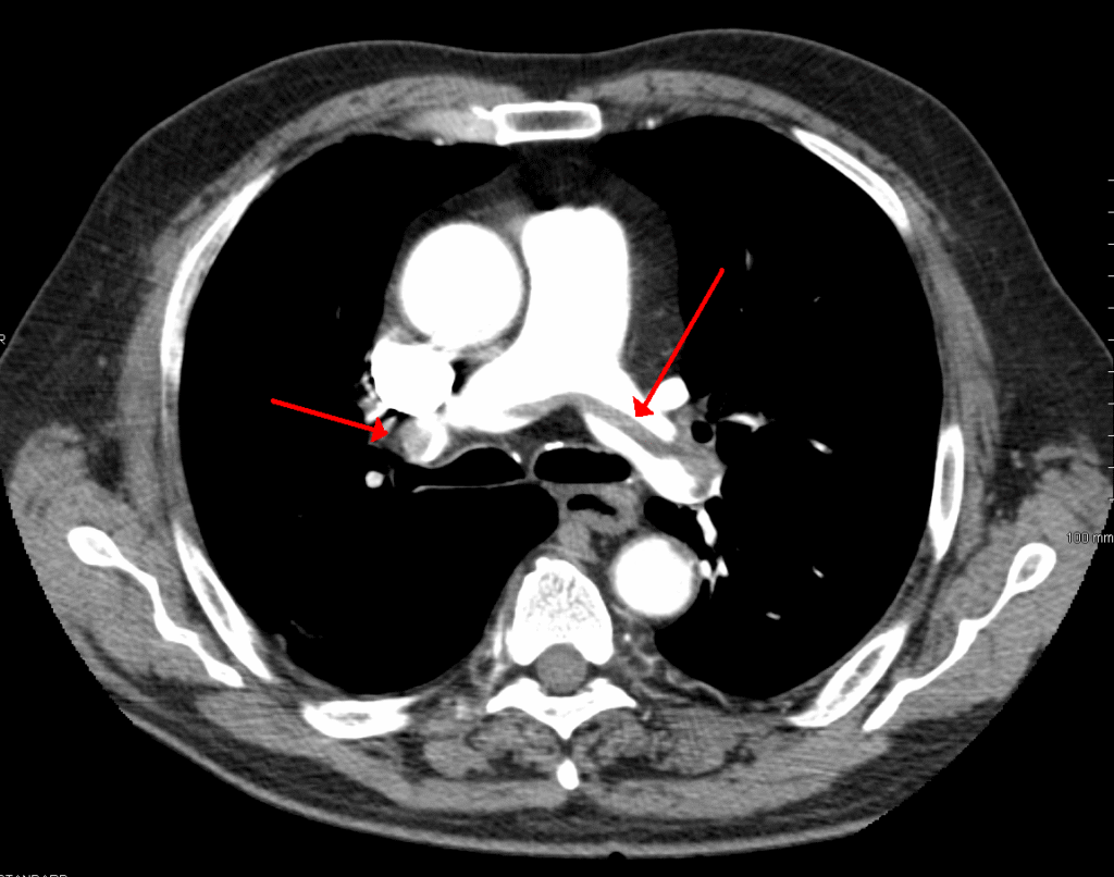 PE detection by CT scan.