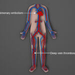 Medical illustration showing the human circulatory system with labels for deep vein thrombosis (DVT) in the lower leg and pulmonary embolism in the lungs, highlighting how blood clots from DVT can travel to the lungs and cause serious complications.