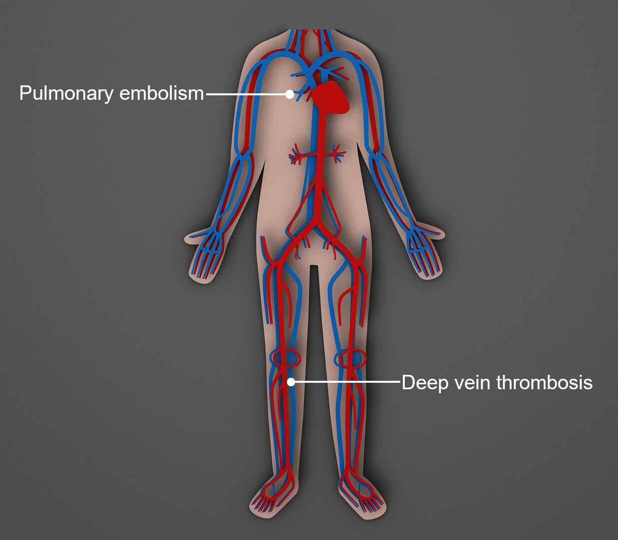 Medical illustration showing the human circulatory system with labels for deep vein thrombosis (DVT) in the lower leg and pulmonary embolism in the lungs, highlighting how blood clots from DVT can travel to the lungs and cause serious complications.