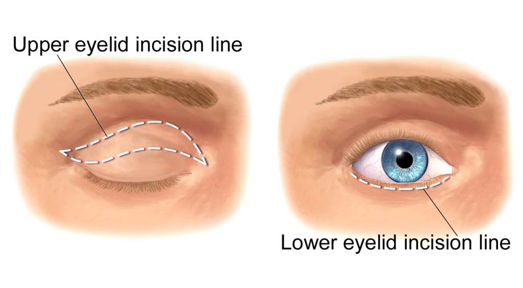 An image showing incision lines in blepharoplasty surgery.