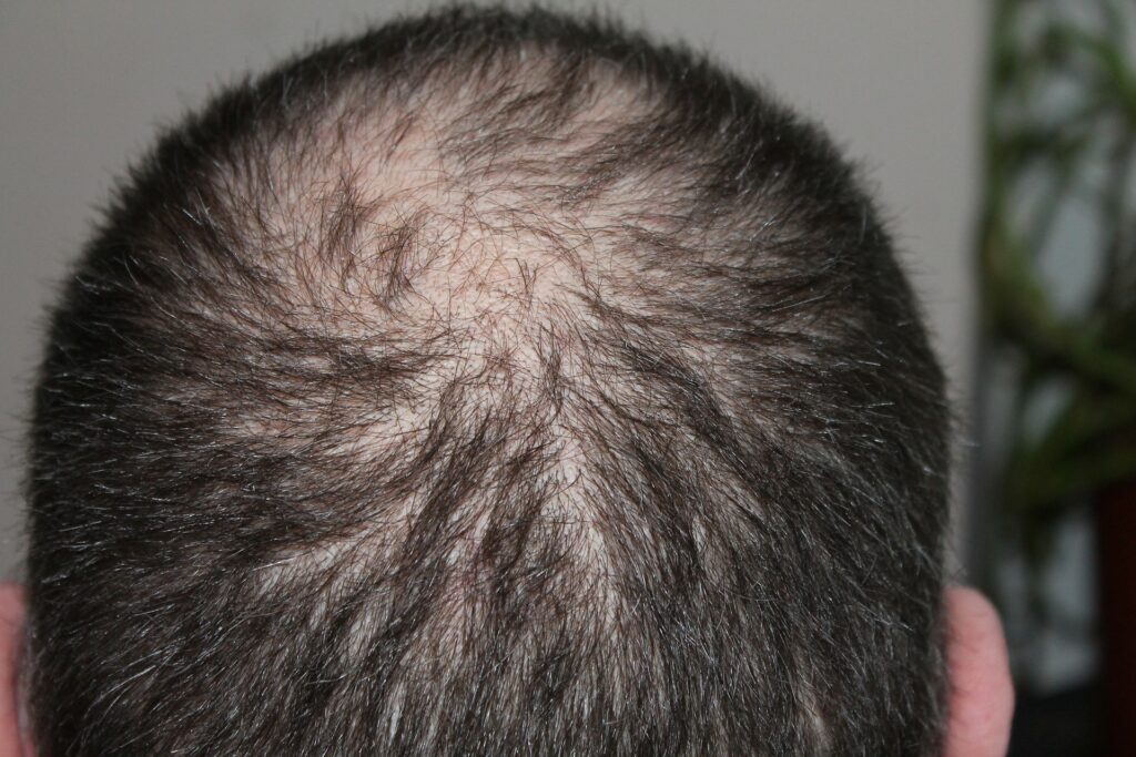A man's hair thinning at the crown towards the back.