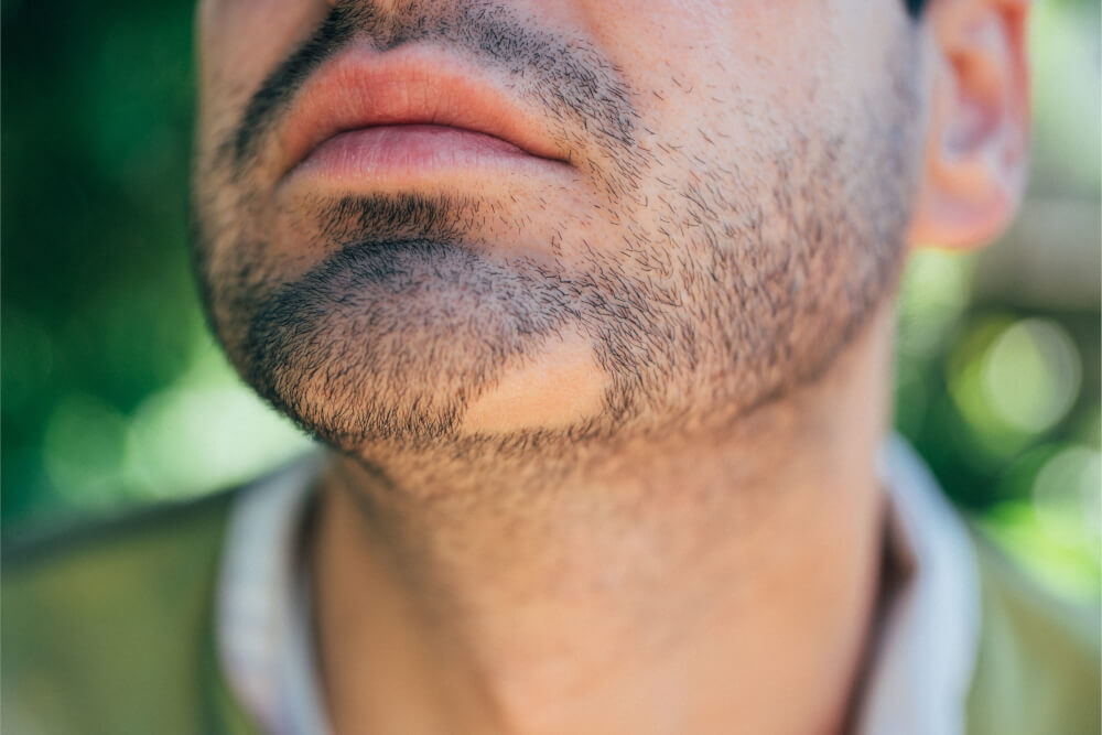 Smooth bald spot on the chin with short stubble around it, demonstrating the typical pattern of alopecia barbae.